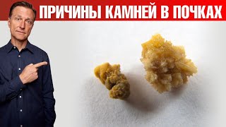 Обнаружена главная причина камней в почках📢