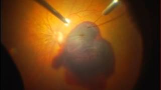 Subretinal rTPA injection in subretinal mass hemorrhage in AMD