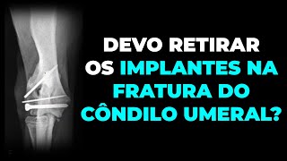 Devo retirar os implantes na fratura do côndilo umeral?