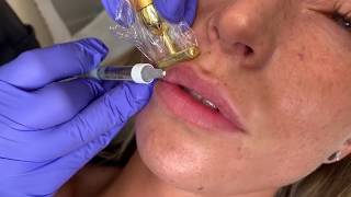 Lip filler injections - using a vibration tool as a distraction method