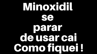 Minoxidil se parar de usar cai - olhem como fiquei, 6 meses sem usar - retomando tratamento