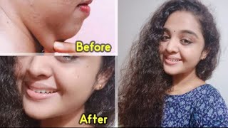 How to Get Rid of DOUBLE CHIN🥰 || ഇരട്ടത്താടി ഇനി നമുക്ക് എളുപ്പത്തിൽ കുറക്കാം|| Ponnus Dream World