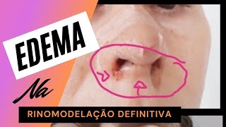 Edema na Rinomodelação Definitiva: Como diminuir.