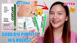 OXECURE ACNE CLEAR POWDER MUD HONEST REVIEW! 6 hours lang tuyo na ang PIMPLE?!