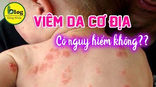 10 Phút tìm hiểu về viêm da cơ địa - tưởng không sao nhưng lại có sao đấy