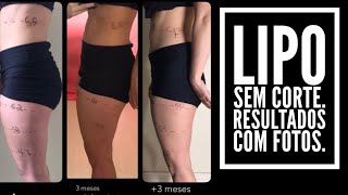 Lipo sem corte- minha experiência com fotos