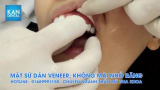 RĂNG SỨ VENEER KHÔNG MÀI NHỎ RĂNG - CÔNG NGHỆ MỚI - KAN DENTAL