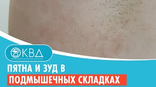 😟 Пятна и зуд в подмышечных складках. Клинический случай №920