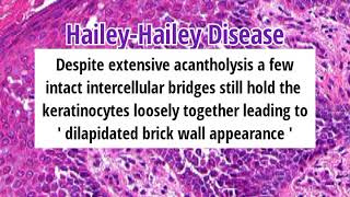 Pathology of Hailey-Hailey Disease by Dr Sampurna Roy MD ( dermatopathology, dermpath)