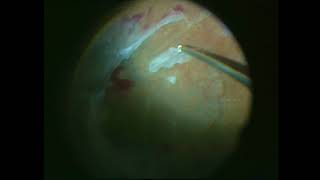 Diabetic Retinopathy - Phacoemulsification - Vitrectomy  - Segmentation