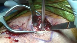 AC Joint Reconstruction | Knotless Coracoclavicular Fixation | Shoulder Specialist