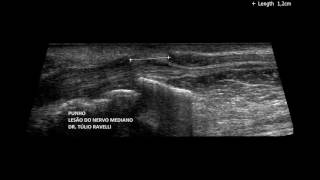 ULTRASSONOGRAFIA DO PUNHO - DR. TÚLIO RAVELLI
