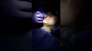 Teeth Polishing