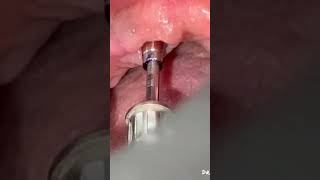 Implant Impression Technique