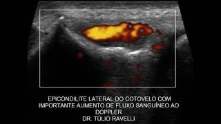 ULTRASSOM DO COTOVELO - EPICONDILITE LATERAL COM FLUXO AO DOPPLER