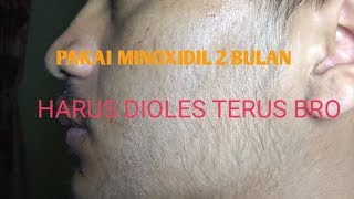 PEMAKAIAN MINOXIDIL KIRKLAND 5% BULAN KE 2 #MINOXIDIL