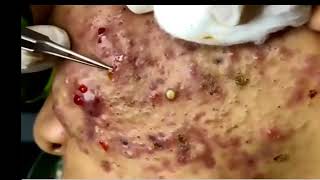 Blackheads & Milia, Big Cystic Acne Blackheads Extraction Whiteheads Removal Bad skin