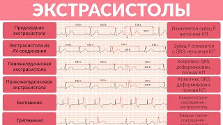 ЭКГ Разбор Экстрасистолы