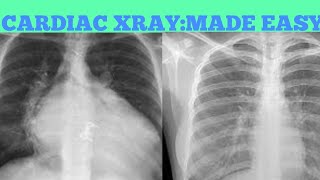 Cardiac X-RAY interpretation|Dr Bhupendra Shah|medicine classroom