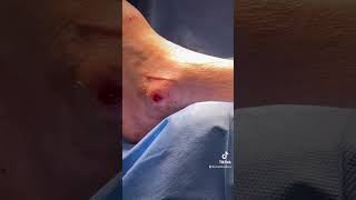 Watch Here: Split Thickness Skin Graft #procedure #doctor #podiatrist