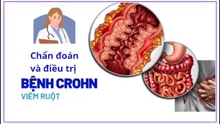 Chẩn đoán và điều trị bệnh Crohn