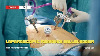 Laparoscopic Removed Gallbladder