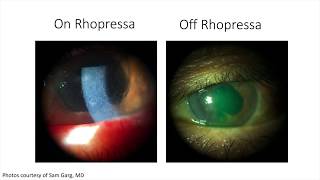 Reticular Bullous Epithelial Edema With ROCK Inhibitor Therapy (Malik Y. Kahook, MD)