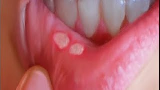 صحت نیوزدا ما شومانو دا خلی د زخم علاج ضرور اوگوری#mouthsores #mithulcer