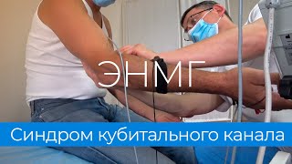 Исследование проведения по нерву (стимуляционная ЭНМГ). Синдром кубитального канала