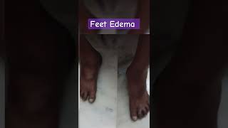 FEET EDEMA