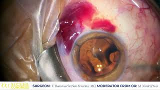 ENG - OCULAR SURFACE RECONSTRUCTION LIVE SURGERY - V. Ramovecchi (San Severino Marche, MC)