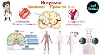 Диагностика инсультов в зависимости от локализации поражения в мозге| Правило 4-ёх| Легко и просто|