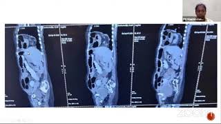 SURGICAL AUDIT ON MORGAGNI HERNIA