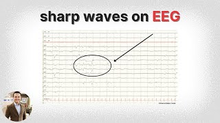 Learn EEG: Positive Spikes and Sharps