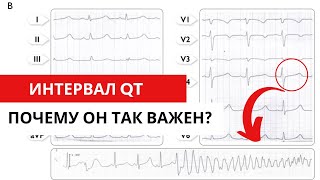 Интервал QT. Как рассчитать? Синдром удлиненного и укороченного интервала QT.