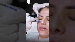 بشرتك معرضة لل Acne scars !!