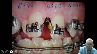 Palatal Separation in Adults