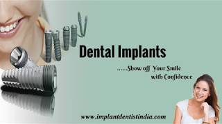 Dental implants In Bangalore | Missing Tooth Replacement in India