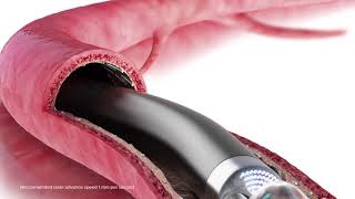 Turbo-Power laser atherectomy animation