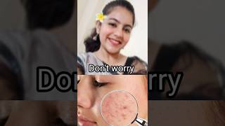 Solution for pimples|Dr.Divyadarshini|BNYS|skincare|tamilhealth|medicaltalks|pimples|clearskin|