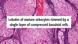 Pathology of Sebaceous Hyperplasia by Dr Sampurna Roy MD