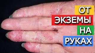 Вот что старые врачи рассказывают. Экземы не будет, если делаешь это и как обезболить суставы