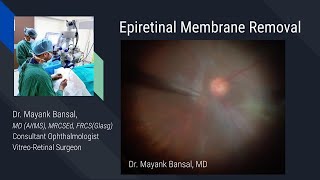 Silicon Oil Removal Surgery with Dense Epiretinal Membrane Removal - Dr. Mayank Bansal MD, FRCS