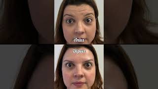 ✨ Explore a Transformação Autêntica! ✨Veja esse Antes x Depois!  #ToxinaBotulinica