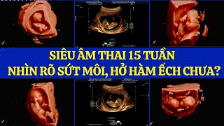 Siêu Âm Thai 15 Tuần Nhìn Rõ Sứt Môi, Hở Hàm Ếch Chưa?#phongkhamphuongthiem#Sieuamthai #sieuam5D