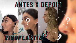 RINOPLASTIA ANTES X DEPOIS TIKTOK | Sra Curiosa