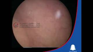 Ureteroscopy - Cystoscopy Male Dr. Ali Mehdi Zadeh Consultant Urologist Doctor in Kuwait