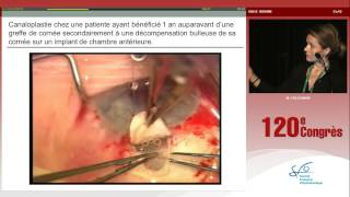 Canaloplastie chez une patiente glaucomateuse ayant subi une greffe cornéenne (N. Collignon)