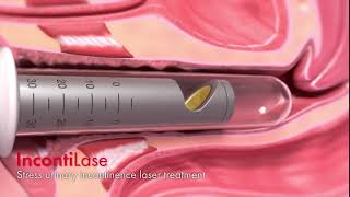 LASERSKA REJUVENACIJA VAGINE