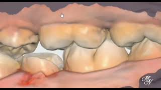 Checking Palatal & Buccal Clearance Using Inta oral scanner